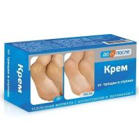 До и после крем для ног от трещин в ступнях 150мл (ТВИНС ТЭК)