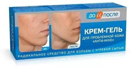 До и после анти-акне крем-гель для проблемной кожи 50мл (Твинс тэк ао)